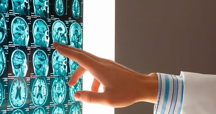 Neurointervencionismo | Insitituto Cardiovascular Rosario