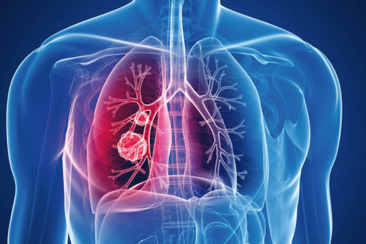 Ateneo de Cardiología - Bibliográfico - Guías de la Sociedad Europea de Cardiología sobre el manejo del tromboembolismo pulmonar